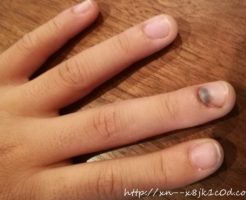 指を挟んだ時の処置の仕方